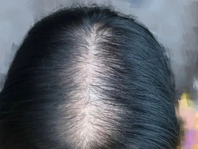 女生脱发是什么原因引起的 影响脱发的因素有什么？（要注意）-第2张图片-蝶芒网